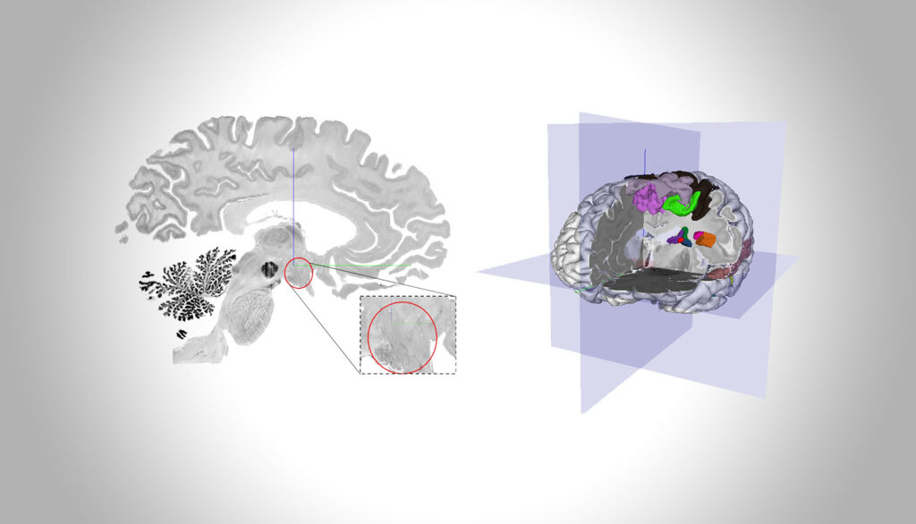 Hochaufgelöste 3D-Kartierung des menschlichen Hypothalamus in 10 postmortalen Gehirnen