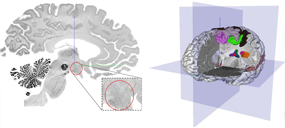 Hochaufgelöste 3D-Kartierung des menschlichen Hypothalamus in 10 postmortalen Gehirnen